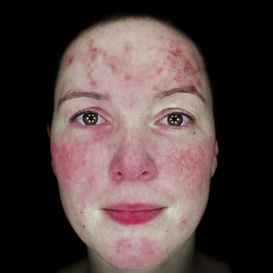 Vaskulität - Hautanalyse Vaskulität -Bildbasierte Hautanalyse