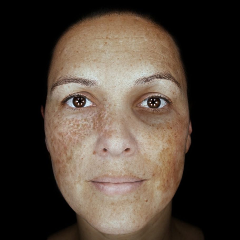 Pigmentierung Hautanalyse Bild Hautanalyse Pigmentierung